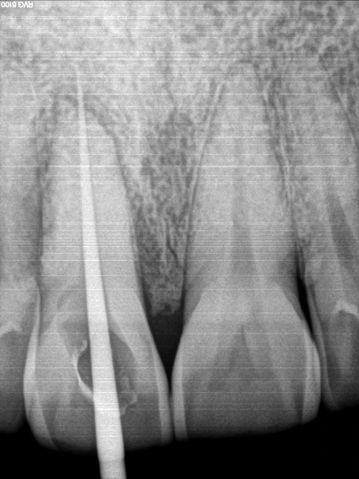 Endodontics Re rootcanal treatment with central incisor having