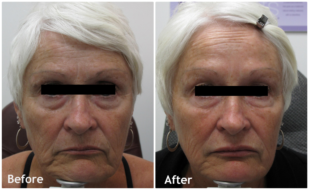 Guelph Medical Laser Before & Afters