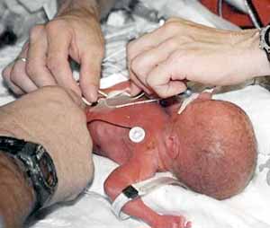 Premature Labor