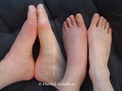 hallux valgus, halluxvalgus-operation, efter op 