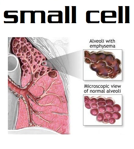 Small cell lung cancer   american cancer society