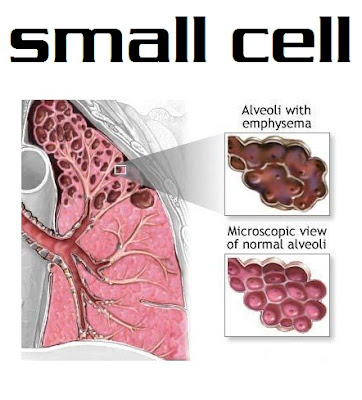 small cell lung cancer | small cell lung cancer image | small cell lung cancer picture | photo small cell lung cancer | symptoms lung cancer | what is lung cancer | treatment lung cancer | lung cancer survival rate | lung cancer prognosis | type of lung cancer