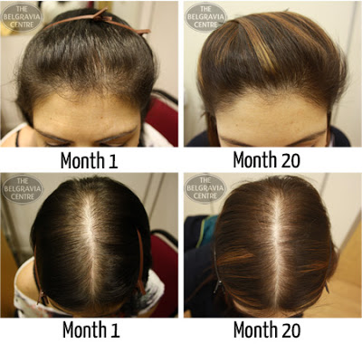 How To Grow Hair Naturally Fast Using Onion Juice Home Remedy