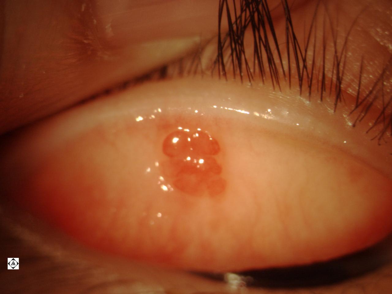 Palpebral conjunctival Papilloma vs. Granuloma Sonoran Desert Eye Center