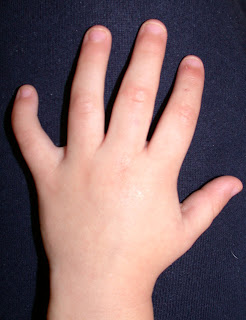 finger little clinodactyly hand curved small ring bending bent arm features congenital towards skin most fetal