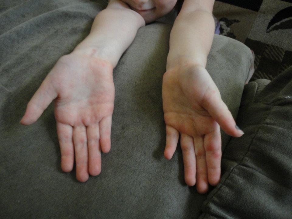 Young Mommy & Wife Hand, foot, and mouth disease in addition to strep!