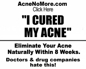 Acne No More Free Download