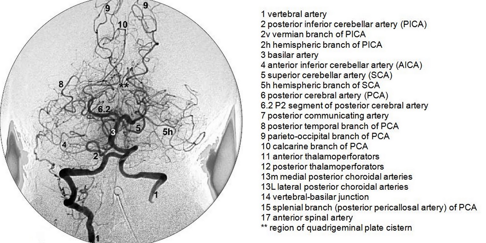 Dr Balaji Anvekar FRCR Normal Brain Angiogram DSA