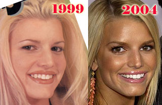 Bigger Eyes Surgery