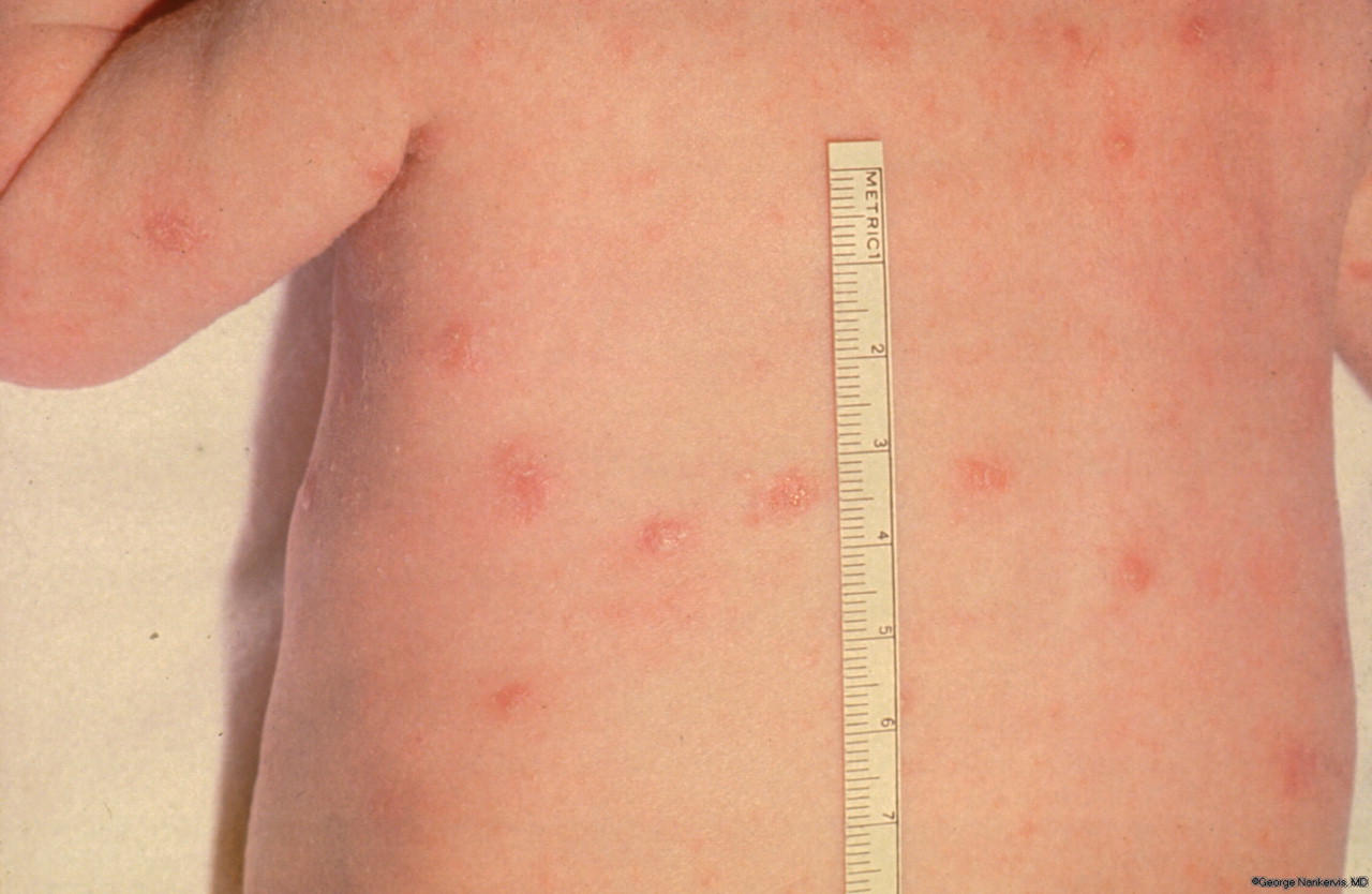 What are the symptoms of a scabies infection?