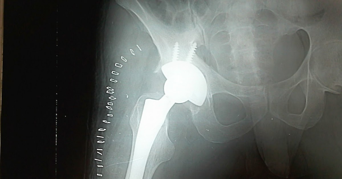 Clinical images Total Hip Replacement
