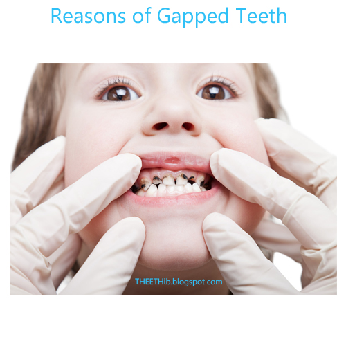 teeth gapped reasons gum