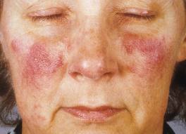 acne overgang