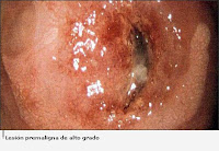 CAUSA DE CANCER DE CUELLO UTERINO causa de cancer de cuello uterino: