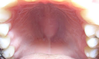 Endolori Toit de la bouche
