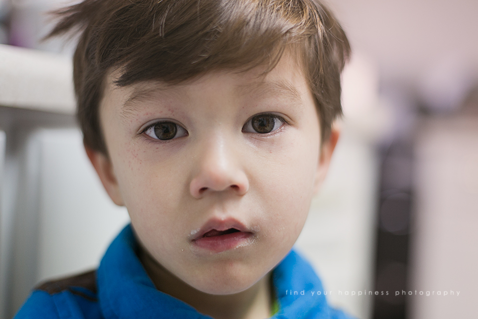 Popped Blood Vessels