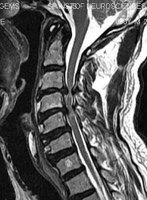 myelopathy cervical stenosis compression spondylotic cord spine spinal degenerative canal mri spondylosis c3 c4 changes hypertrophy uncovertebral c2 anvekar frcr