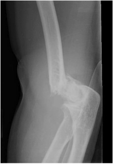 Fracture Distal Humerus