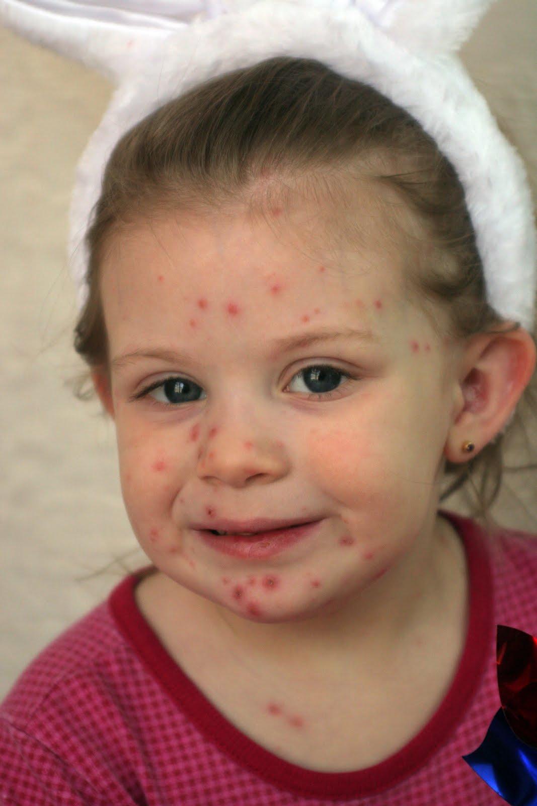 Little Pox