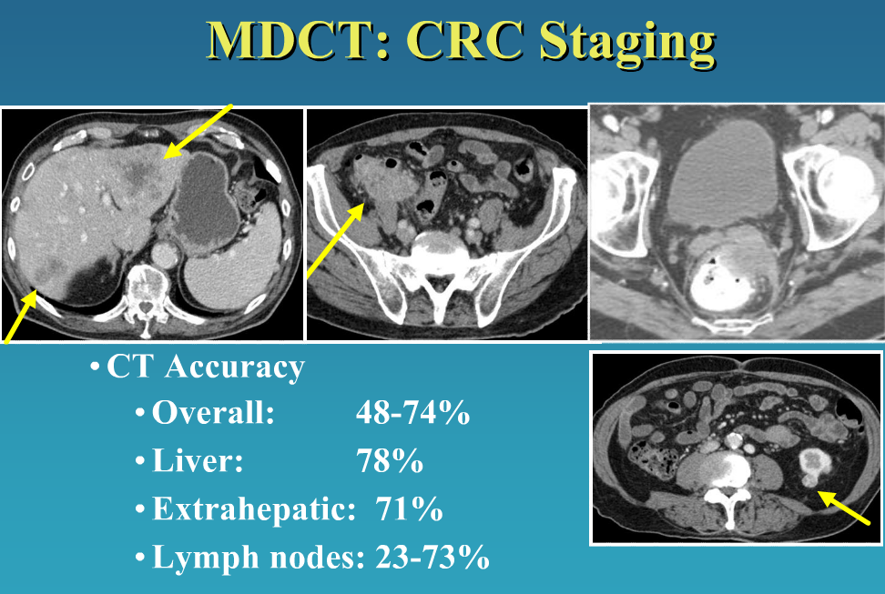 ct colon cancer staging