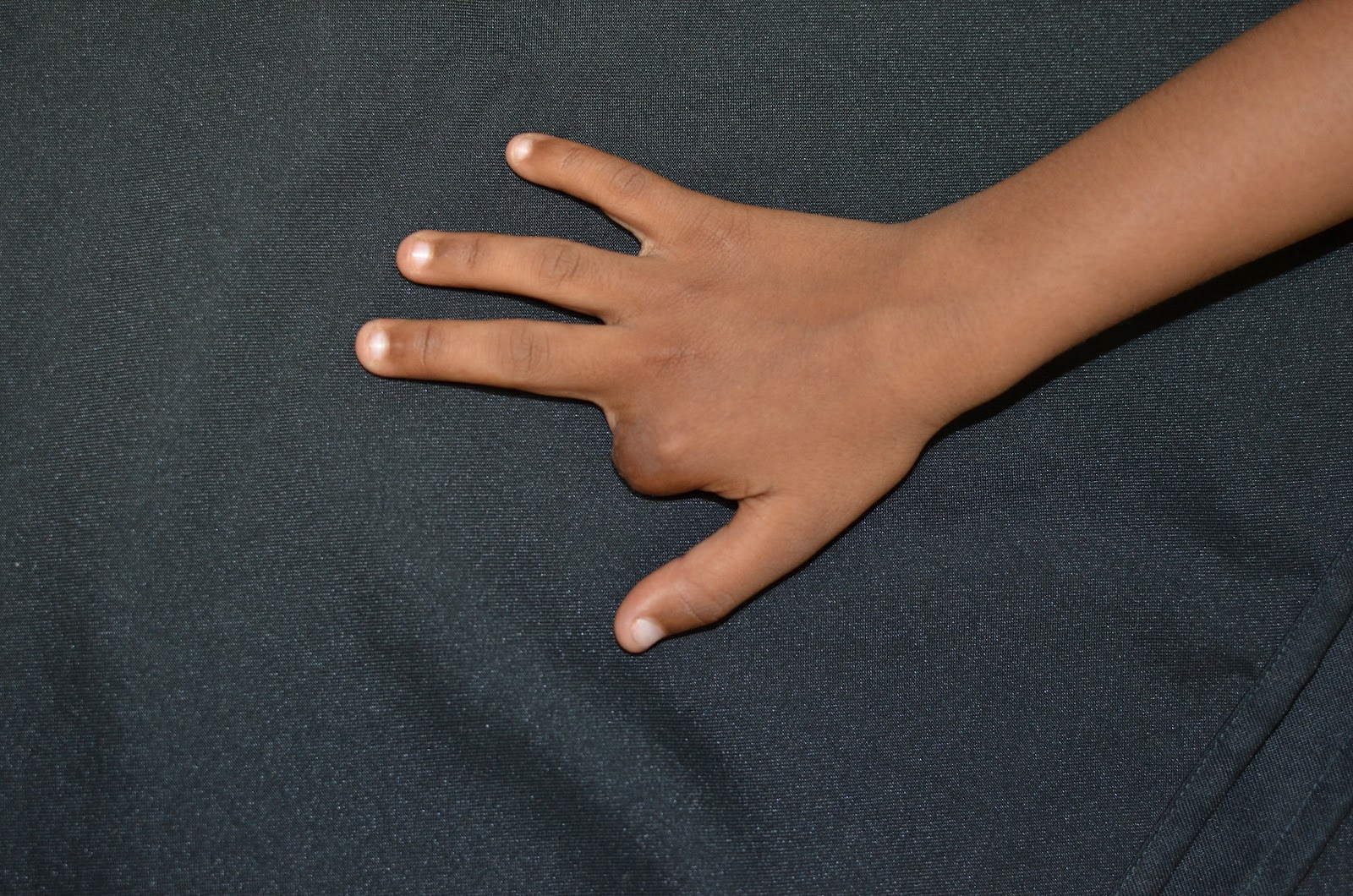 CRUSH INJURIES OF HAND AND UPPER LIMB INJURIES DOG BITE AVULSION