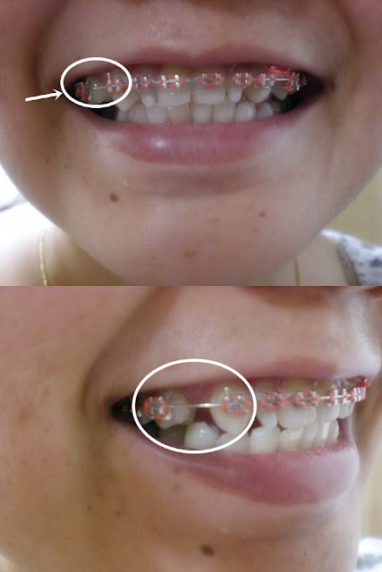 My Braces Elicy: Elastic rubber came out & My orthodontic brush