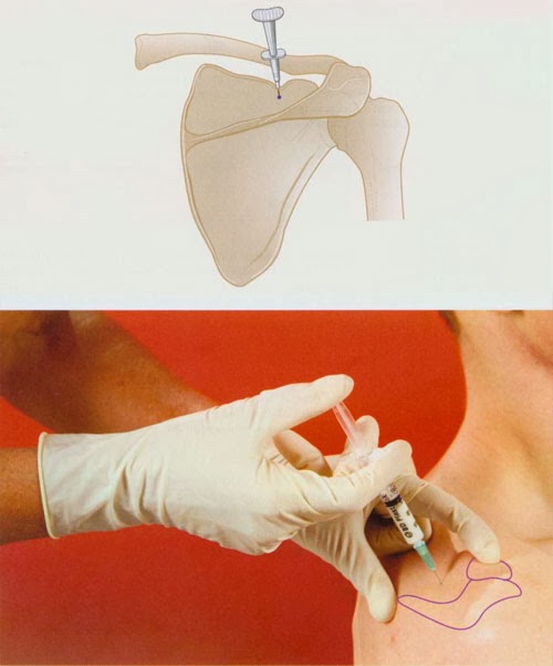 Suprascapular Nerve Injection Nursing