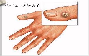 Vision الثآليل الجلدية