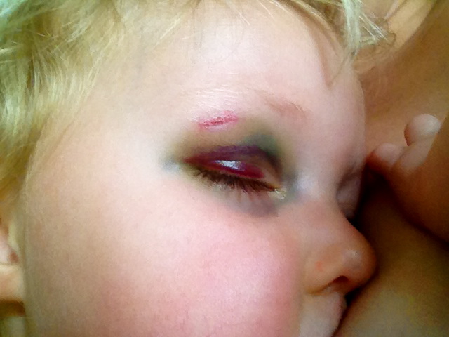 black eye remedies