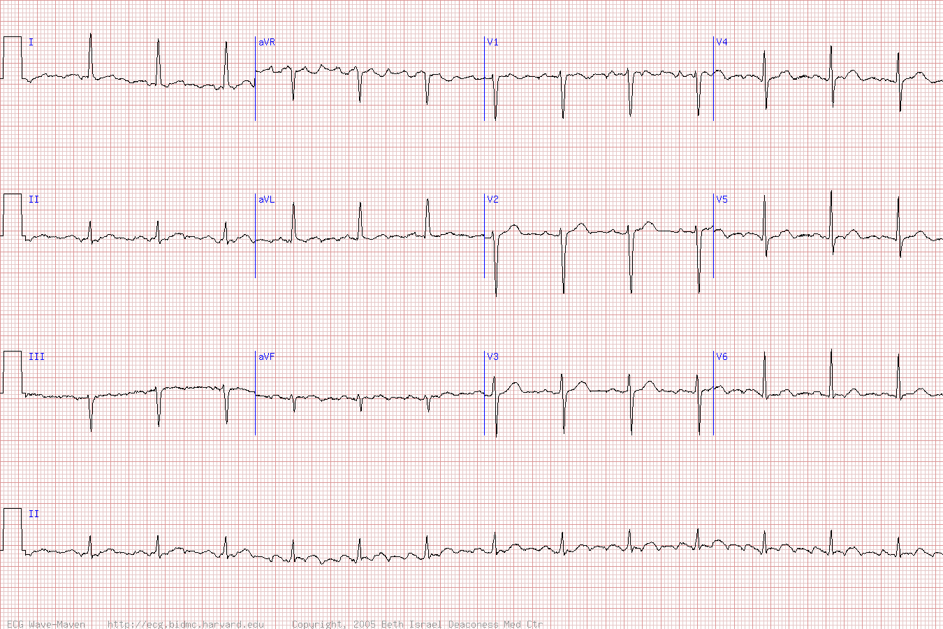 ekg chart gallery reading an ekg chart