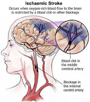 7 Gejala Stroke Iskemik 7 Gejala Stroke Iskemik