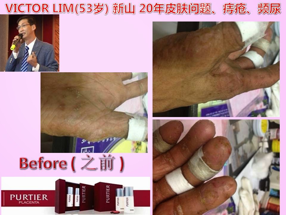 VICTOR LIM (53) JOHOR BAHRU-20 YEARS ECZEMA, PILE, ENURESIS (URINATE PROBLEM)