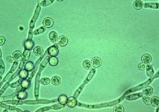 Candidiasis , Candida albicans Gambar Candidiasis , Candida albicans