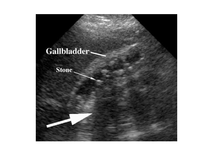 HEALTH FROM TRUSTED SOURCES Gallbladder disease