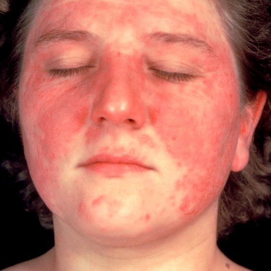 MODIFIED CRITERIA FOR THE DIAGNOSIS OF SYSTEMIC LUPUS ERYTHEMATOSUS