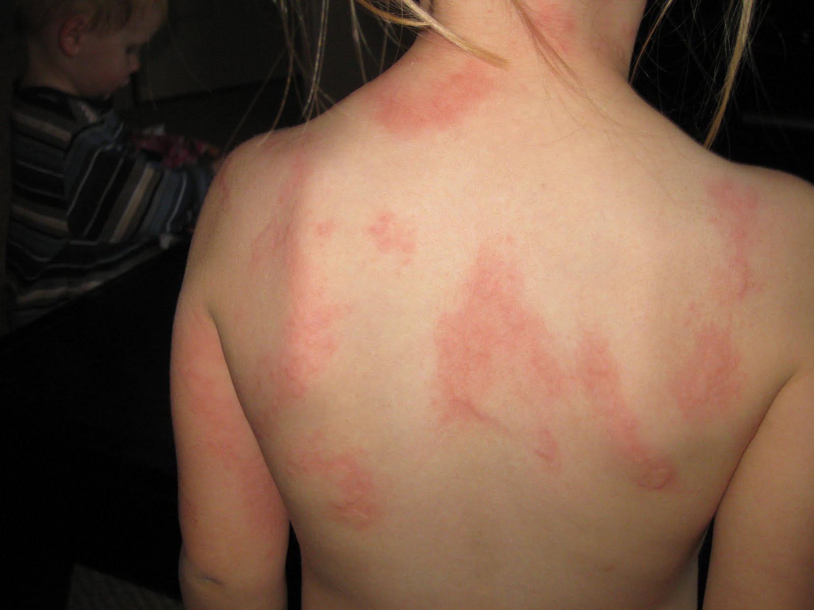 Stress Related Hives