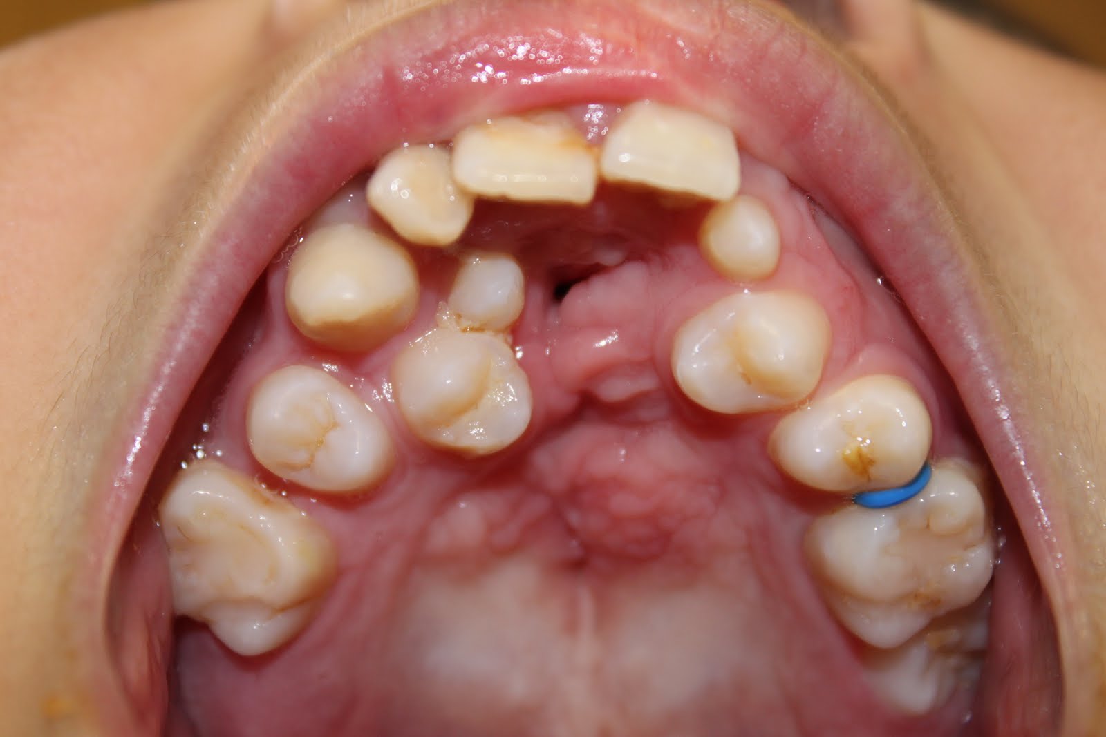 There's still a fistula there