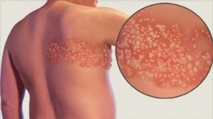 La osteoporosis sheynogo del departamento de la columna vertebral de la causa