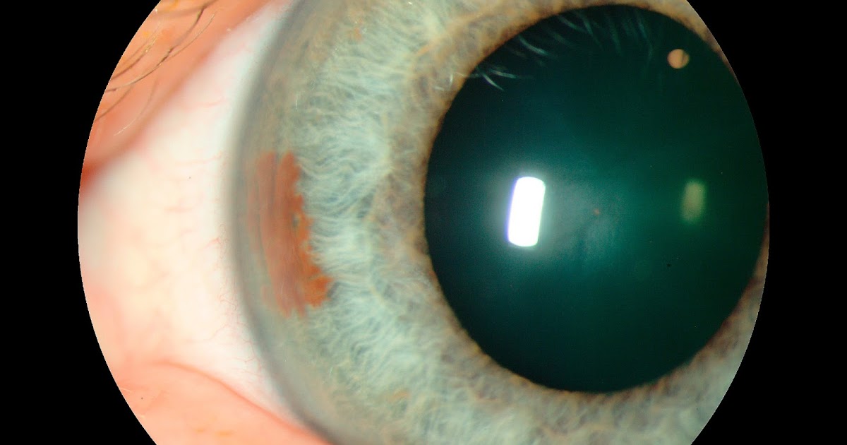 Whitman Images Iris Nevus