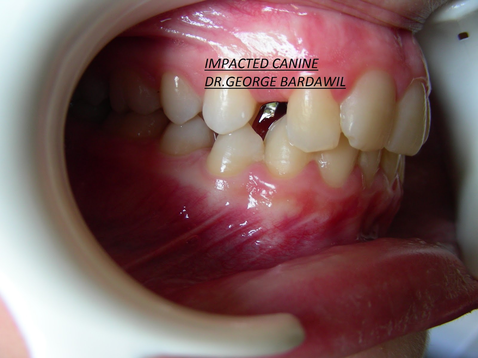 E. BardawilOrthodontistInvisalign Diamond level IMPACTED