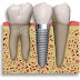Faça implantes dentários!