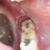 Pergunta do Cliente 6 - Dentes sisos são úteis?