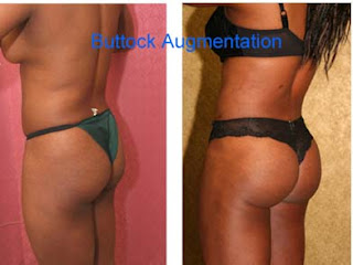 Beverly Hills tummy tuck