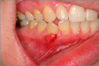 gum tumor lump pregnancy oral periodontist michigan before tissue swelling growths bloomfield birmingham disease hills