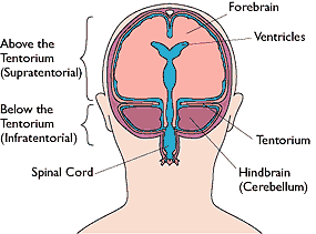 brain herniation