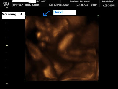 3d ultrasound pictures of twins. 3d ultrasound pictures of