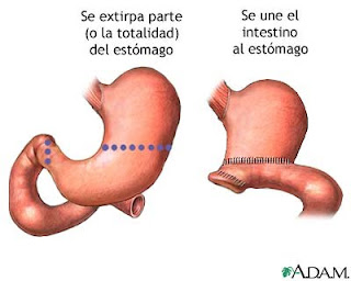 CANCER GASTRICO GASTRECTOMIA cancer gastrico gastrectomia: