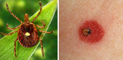 Yozgat Muhabir: Kene ısırması sebebiyle hayatını kaybetti