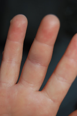 Stoved Finger
