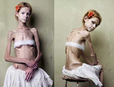 anorexia UPDATE December 10 2008 I'd like to share with you a comment I